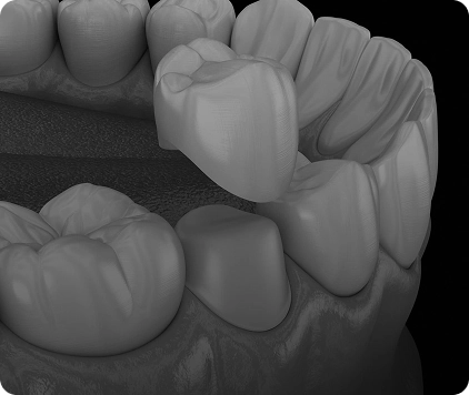 Dental Crowns