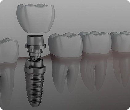 Dental Implants