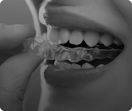Clear Aligners 